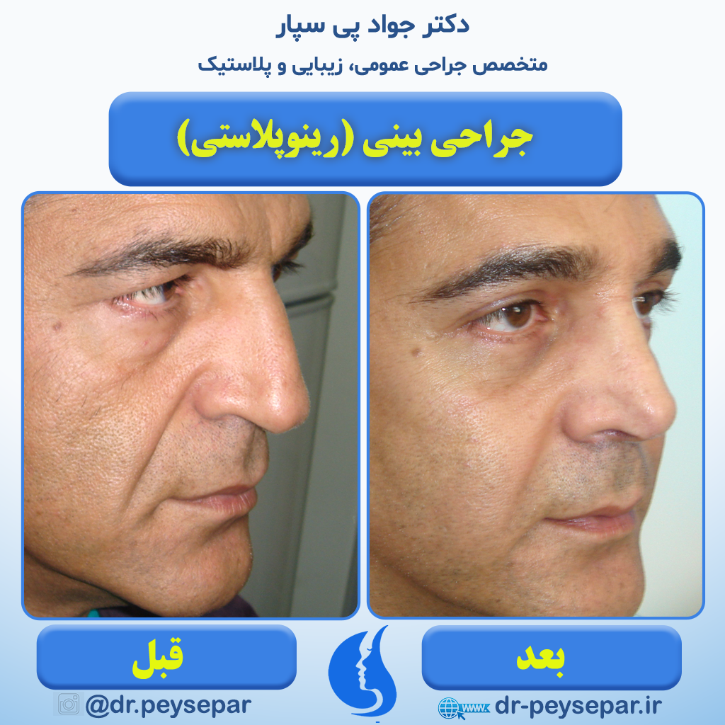 جراحی زیبایی بینی دکتر جواد پی سپار