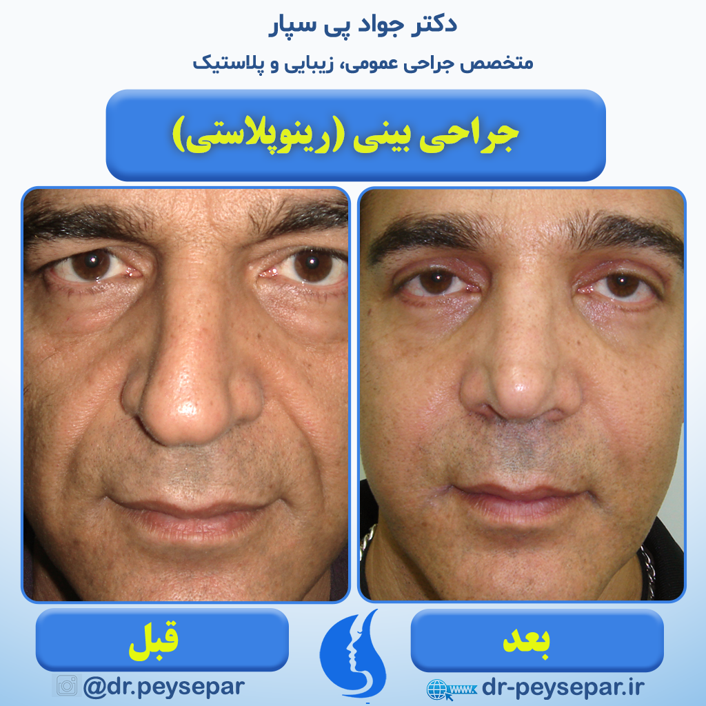 جراحی زیبایی بینی دکتر جواد پی سپار