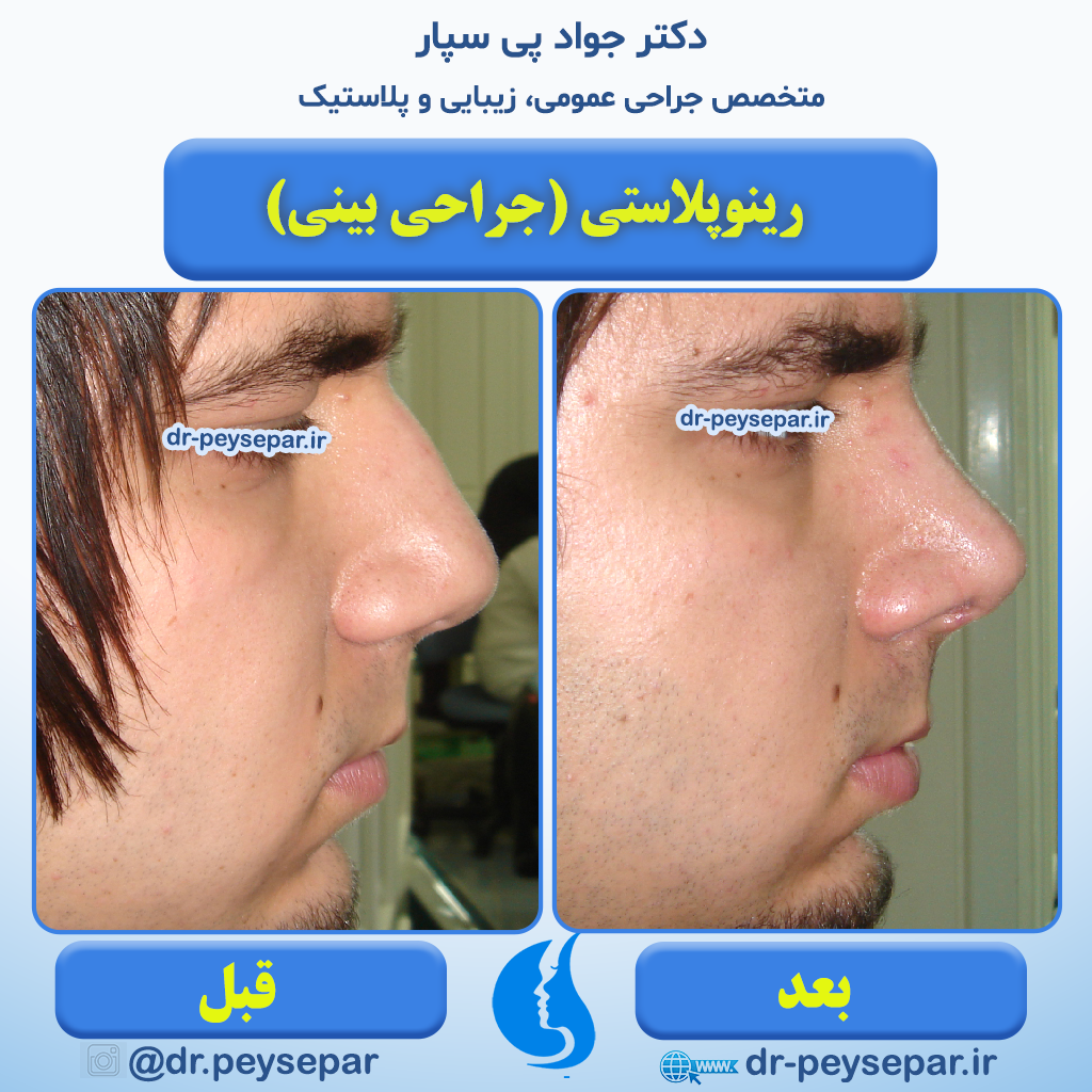 نمونه جراحی زیبایی بینی ( رینوپلاستی ) دکتر جواد پی سپار متخصص زیبایی اهواز
