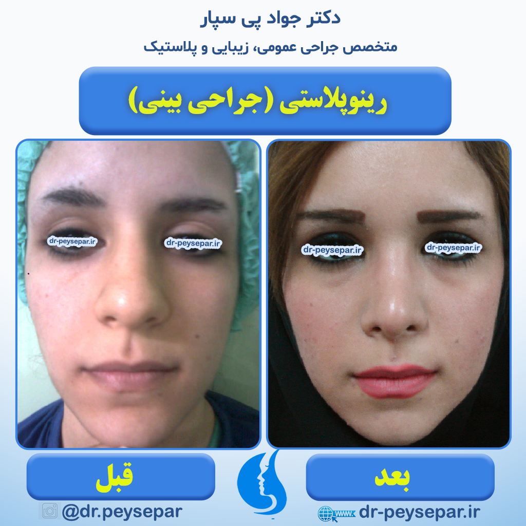 نمونه جراحی زیبایی بینی ( رینوپلاستی ) دکتر جواد پی سپار متخصص زیبایی اهواز
