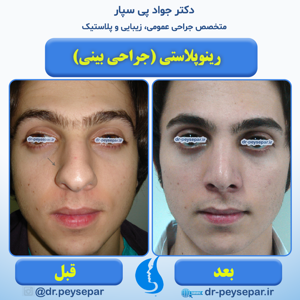 بعد از جراحی بینی چه بخوریم - نمونه جراحی بینی (رینوپلاستی) دکتر جواد پی سپار متخصص جراحی زیبایی در اهواز