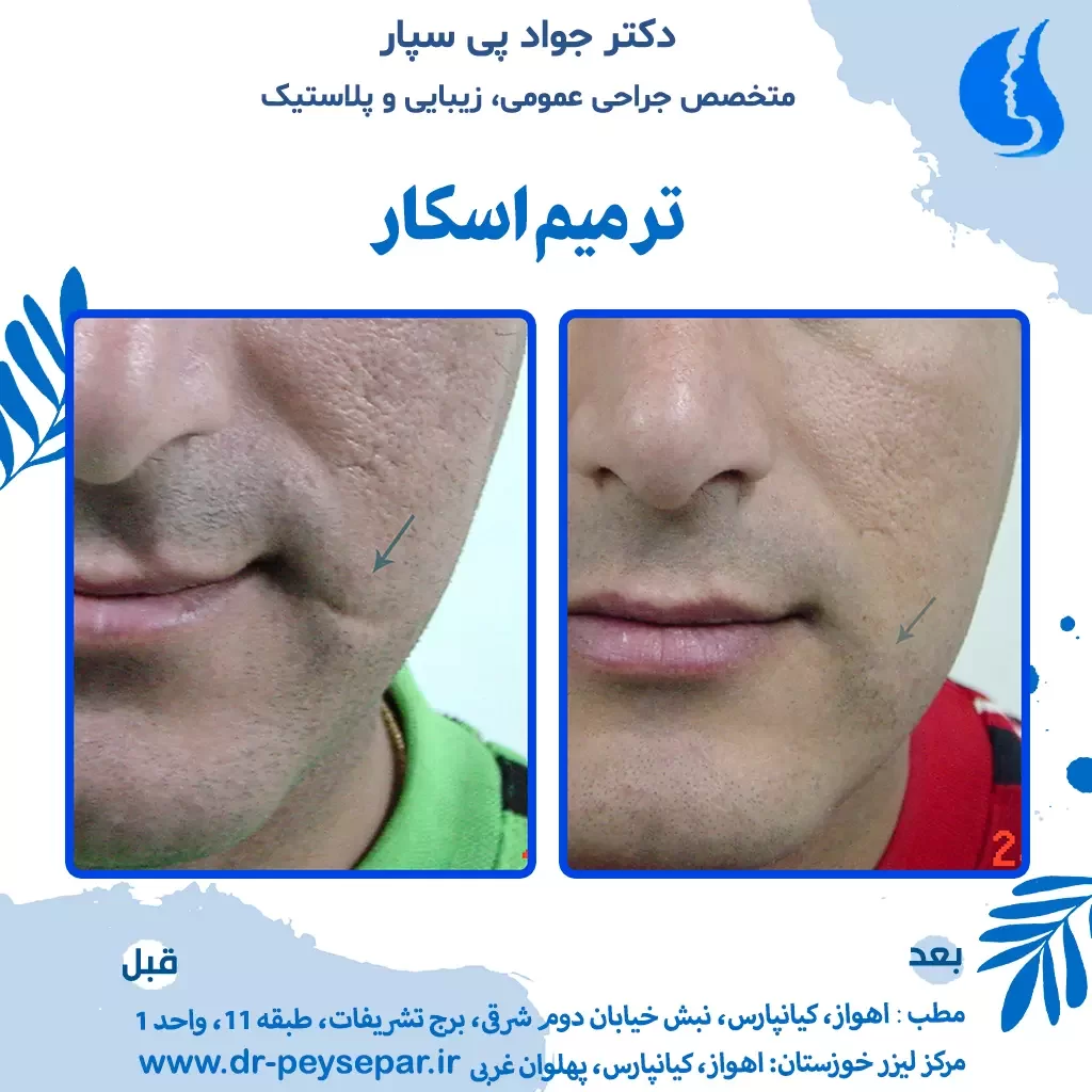 ترمیم جای اسکار زخم تصادف در صورت توسط دکتر جواد پی سپار متخصص جراحی زیبایی و پلاستیک مرکز لیزر خوزستان