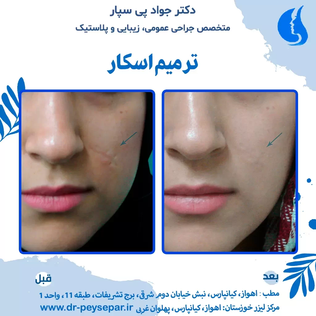 ترمیم جای اسکار زخم در صورت توسط دکتر جواد پی سپار متخصص جراحی زیبایی و پلاستیک مرکز لیزر خوزستان