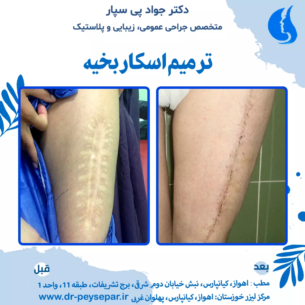 ترمیم جای اسکار زخم جراحی در پا توسط دکتر جواد پی سپار متخصص جراحی زیبایی و پلاستیک مرکز لیزر خوزستان