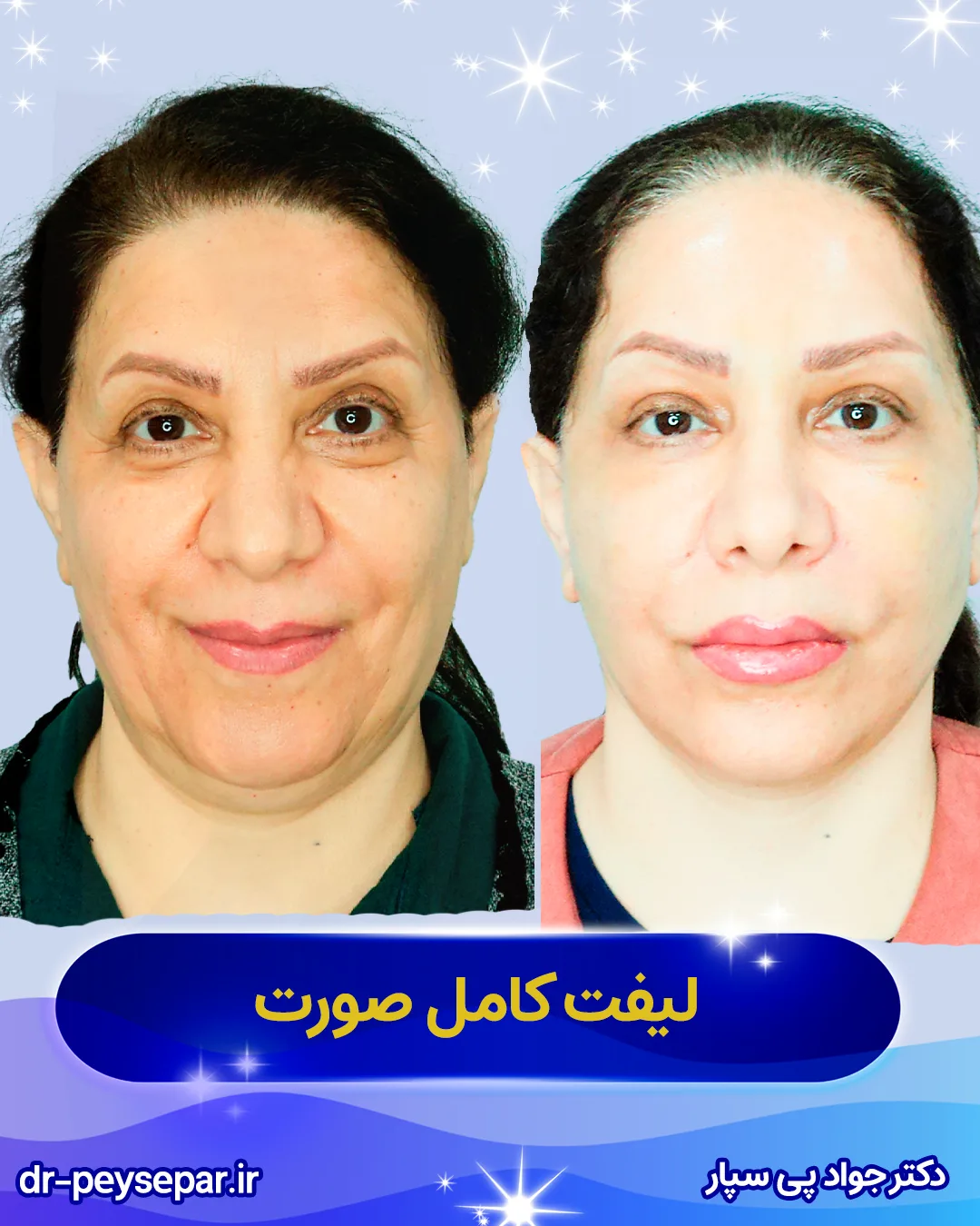 نمونه کار لیفت صورت دکتر پی سپار جراح زیبایی در اهواز