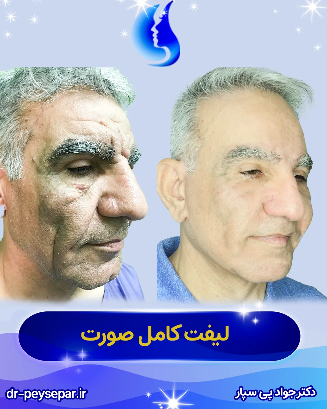 نمونه لیفت صورت بهترین جراح لیفت اهواز دکتر جواد پی‌سپار با 40 سال تجربه جراحی زیبایی