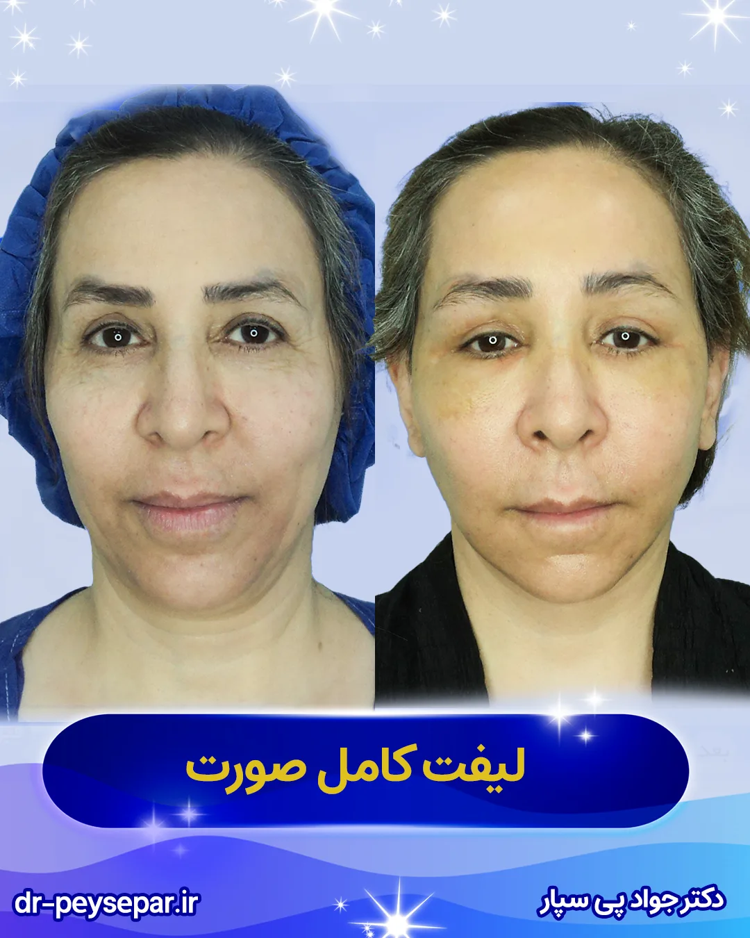 نمونه لیفت صورت بهترین جراح لیفت اهواز دکتر جواد پی‌سپار با 40 سال تجربه جراحی زیبایی