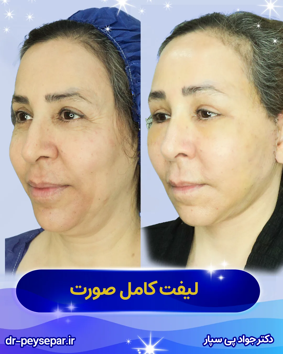 نمونه لیفت صورت بهترین جراح لیفت اهواز دکتر جواد پی‌سپار با 40 سال تجربه جراحی زیبایی