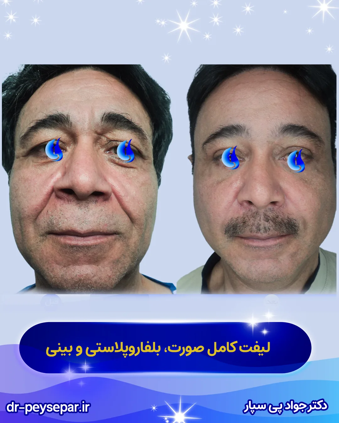 دکتر جواد پی سپار بهترین جراح لیفت صورت در اهواز