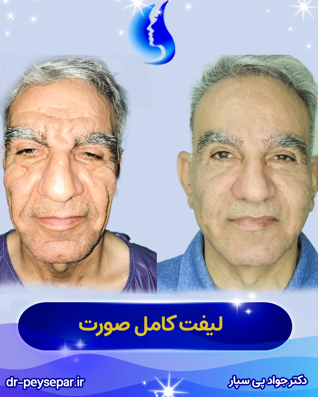 نمونه لیفت صورت بهترین جراح لیفت اهواز دکتر جواد پی‌سپار با 40 سال تجربه جراحی زیبایی