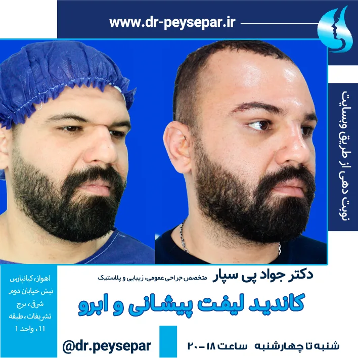 کاندید لیفت پیشانی و ابرو در اهواز - دکتر جواد پی‌سپار