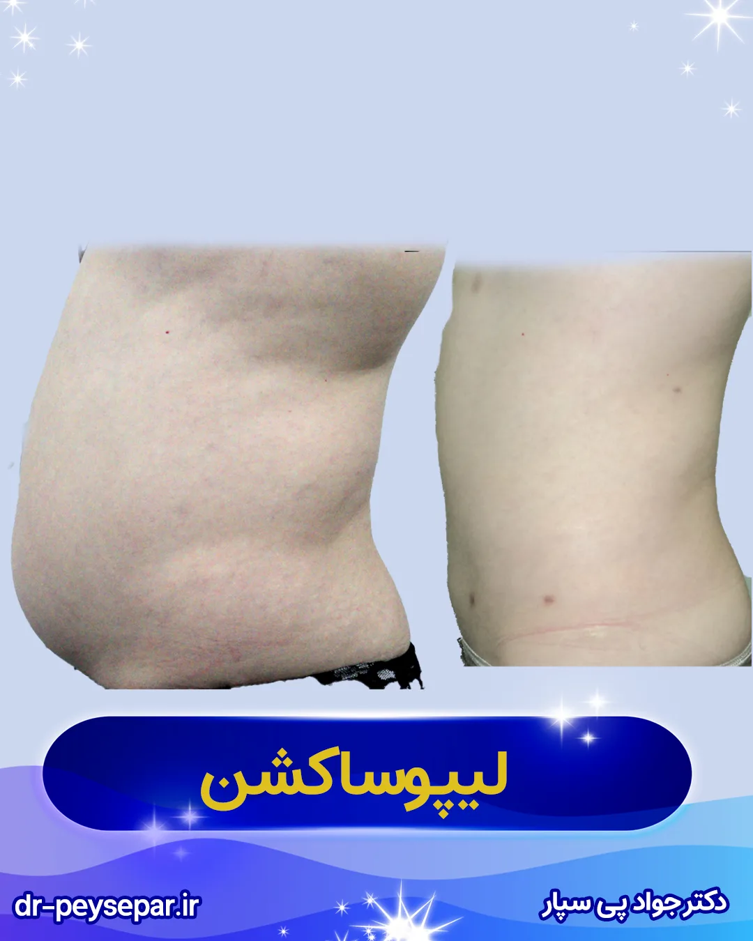 دستورات و مراقبت‌های بعد از لیپوساکشن