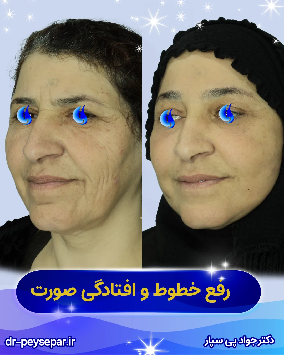 رفع چروک و افتادگی صورت با جراحی لیفت صورت