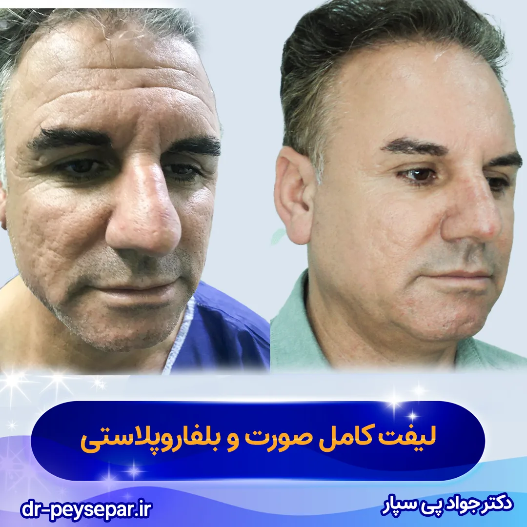 نمونه کار لیفت صورت دکتر پی سپار جراح زیبایی در اهواز