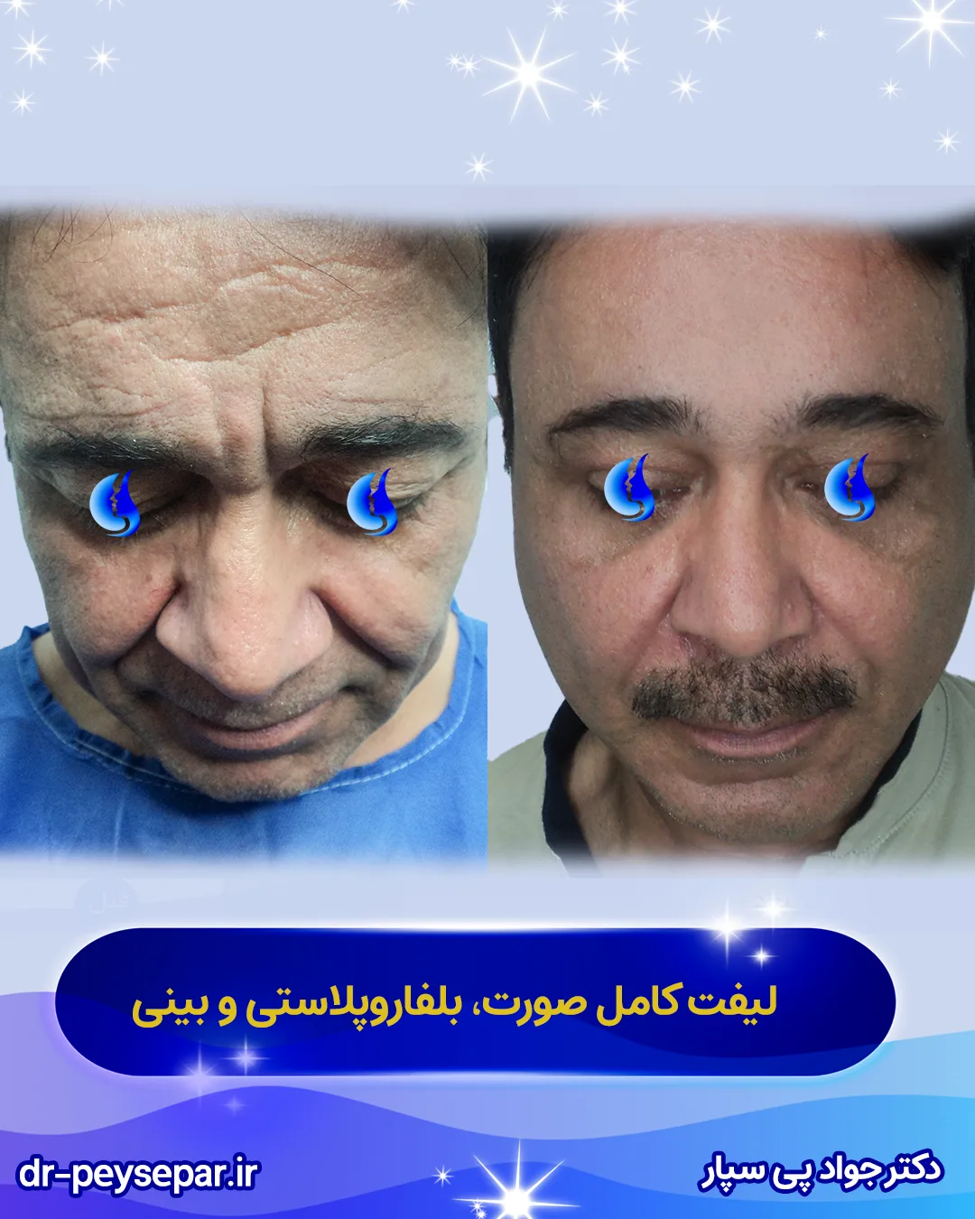 نمونه کار لیفت صورت و بینی دکتر پی سپار جراح زیبایی در اهواز