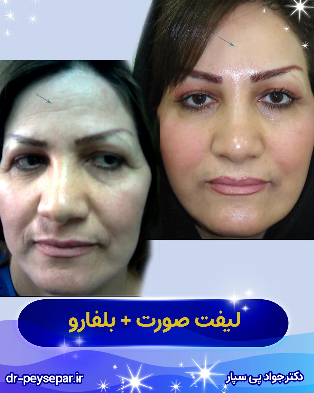 بهترین جراح لیفت صورت در اهواز – قبل و بعد لیفت صورت خانم – دکتر پی‌سپار