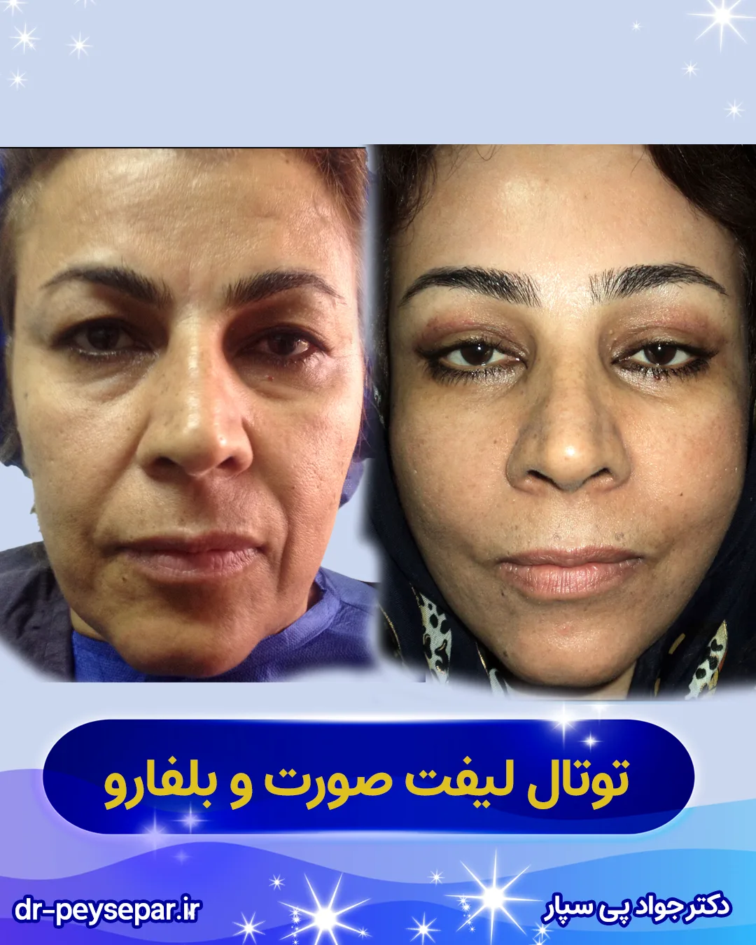 بهترین دکتر زیبایی صورت در اهواز – نمونه قبل بعد لیفت صورت خانم – دکتر پی‌سپار