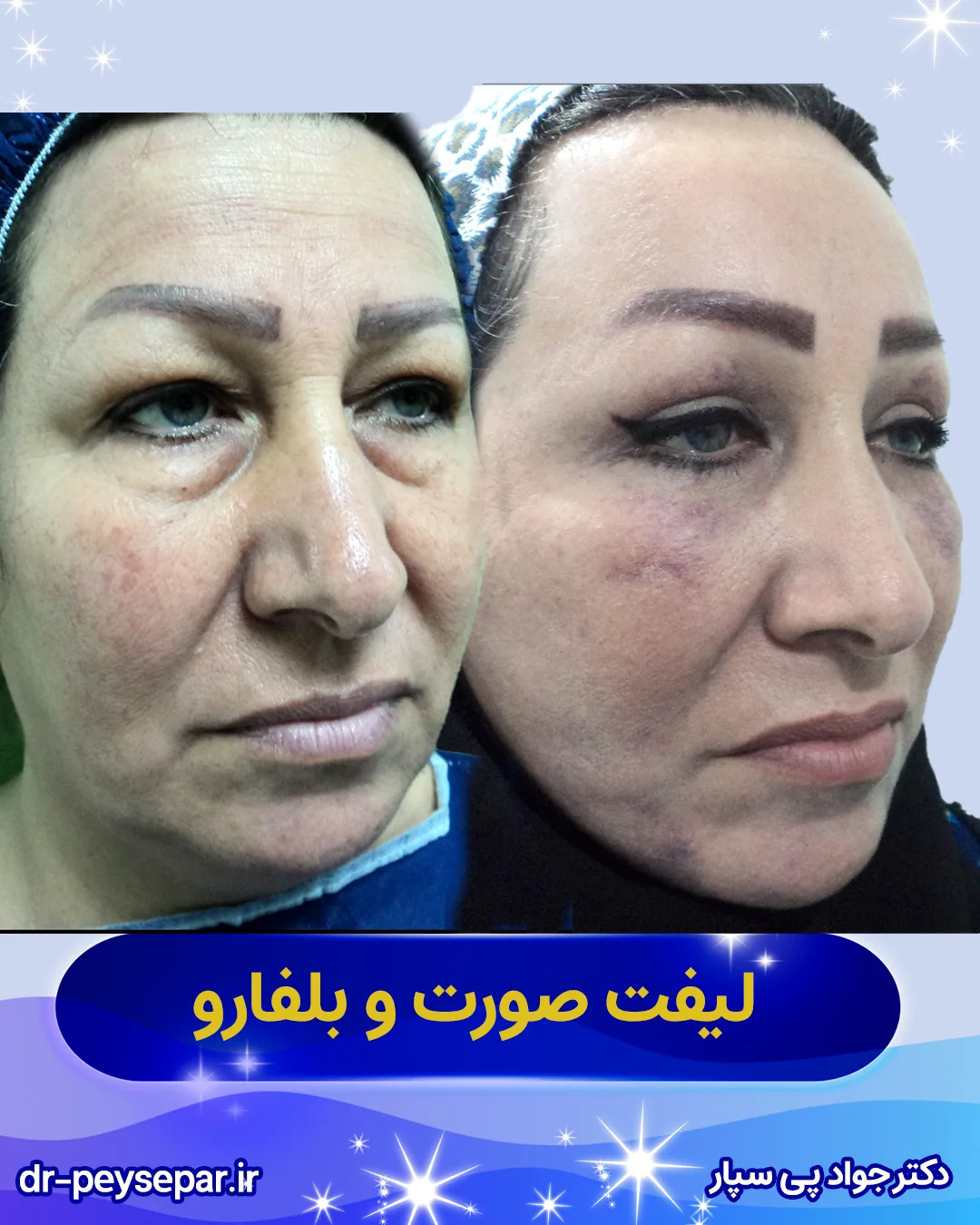 نتیجه لیفت صورت با حفظ حالت طبیعی چهره – اهواز، دکتر پی‌سپار