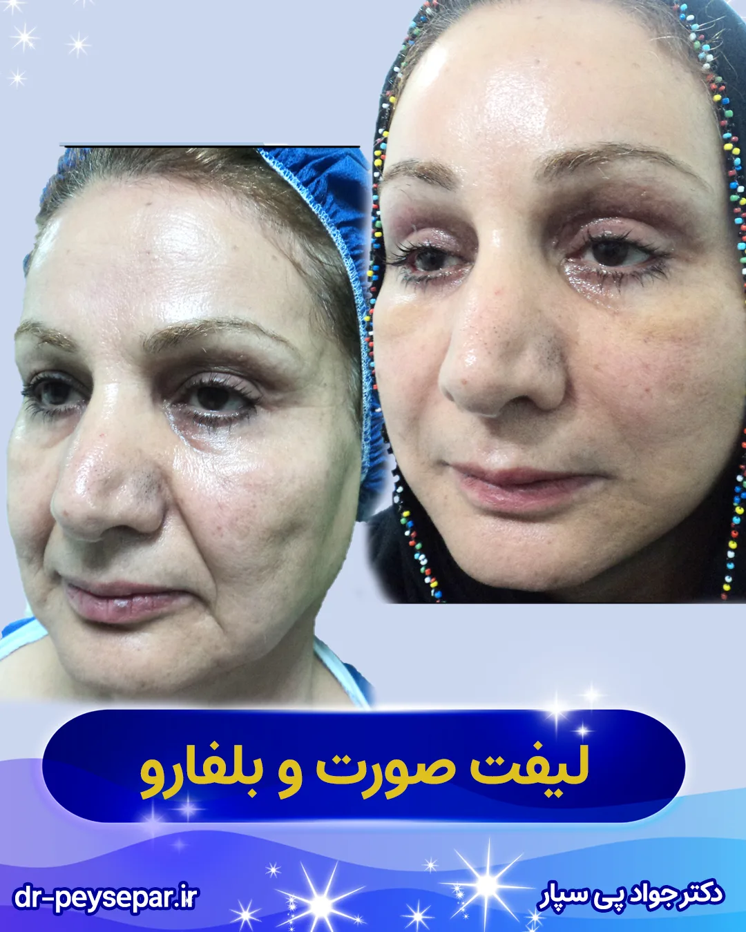 قبل و بعد لیفت صورت در اهواز توسط دکتر جواد پی‌سپار – نمای روبه‌رو