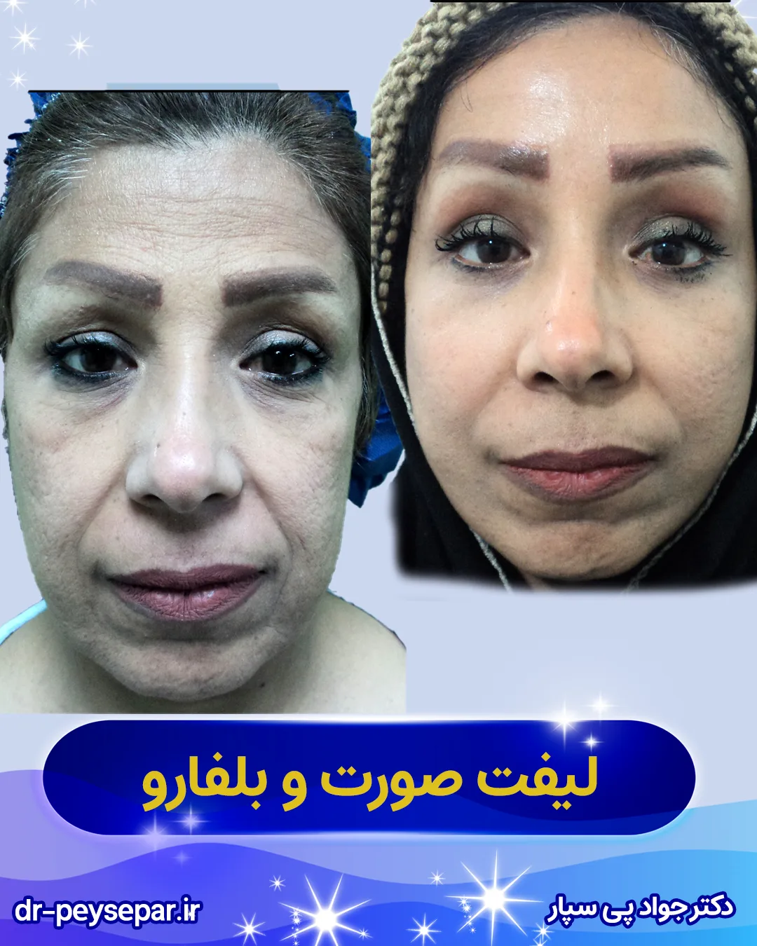 قبل و بعد لیفت صورت – بهبود فرم صورت – اهواز دکتر پی‌سپار
