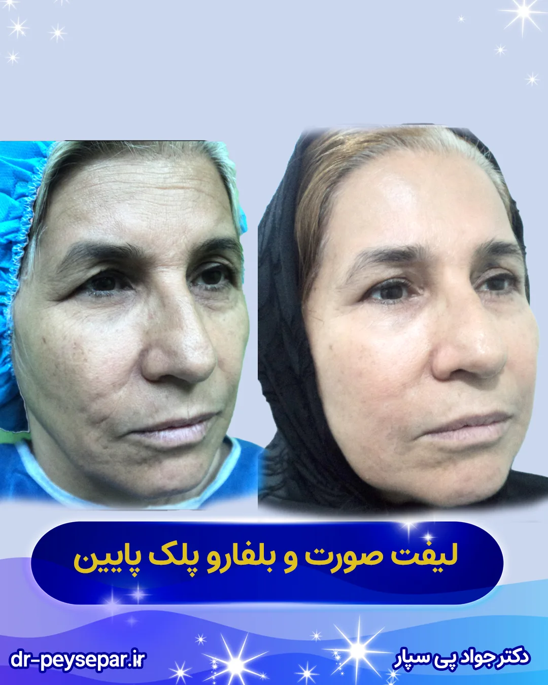 بهترین جراح زیبایی در اهواز – عکس قبل و بعد فیس لیفت خانم – دکتر پی‌سپار
