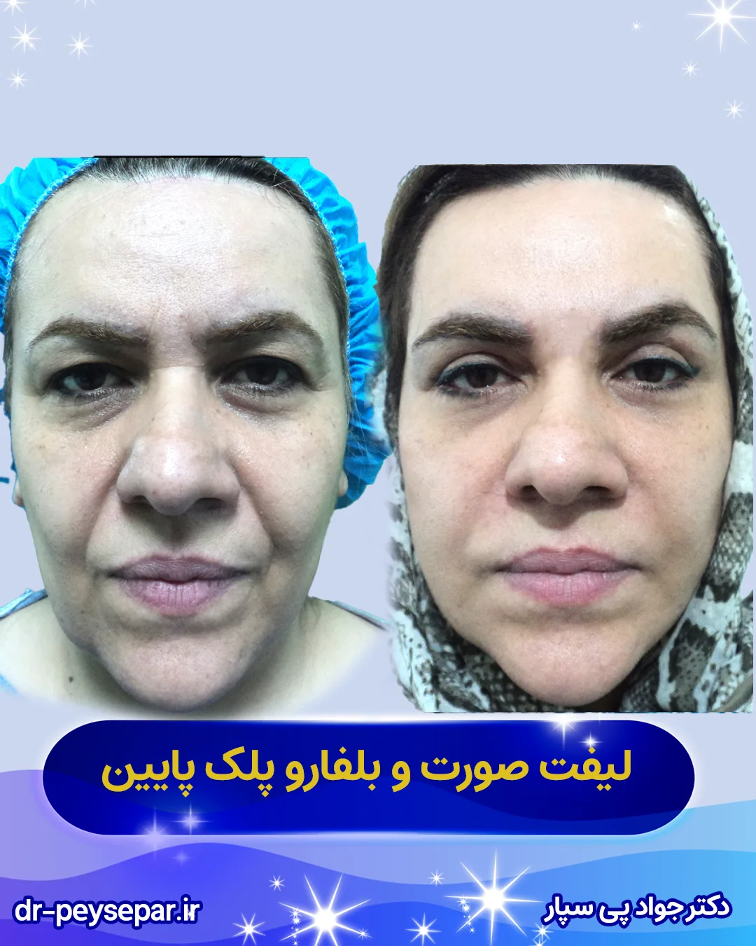 نتیجه لیفت صورت با حفظ حالت طبیعی چهره – اهواز، دکتر پی‌سپار.