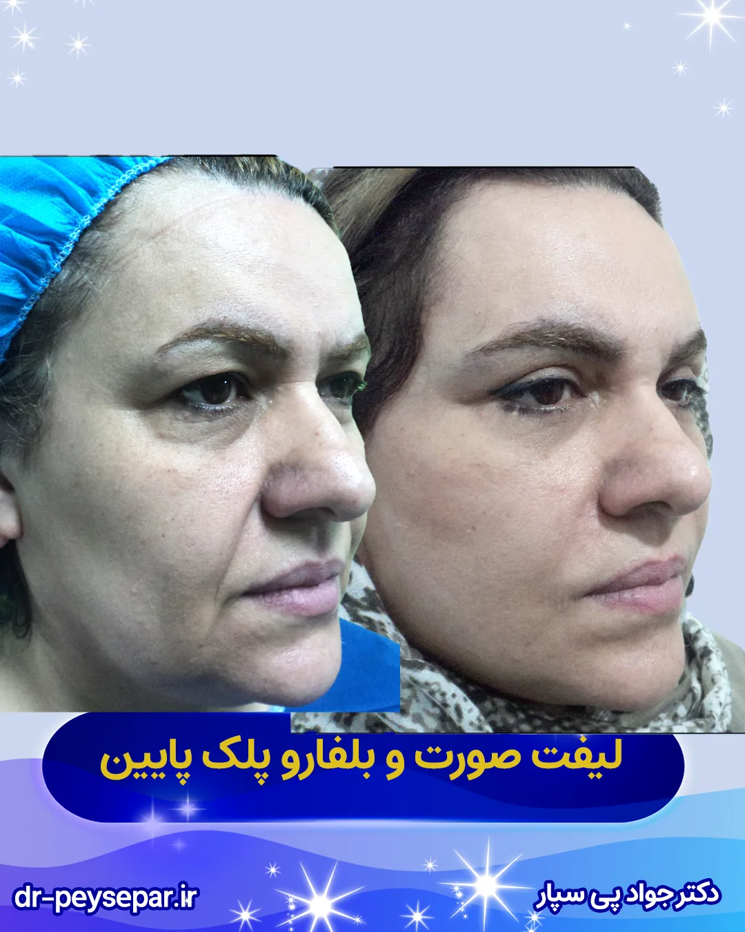 اگر به دنبال بهترین جراح لیفت صورت در اهواز هستید، نمونه نتایج قبل/بعد را در گالری ببینید – دکتر پی‌سپار.
