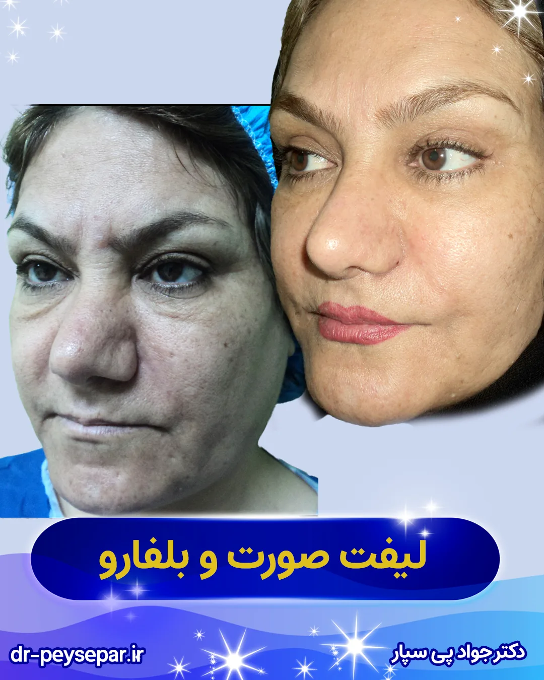 قبل و بعد جراحی لیفت صورت خانم در اهواز توسط دکتر پی‌سپار