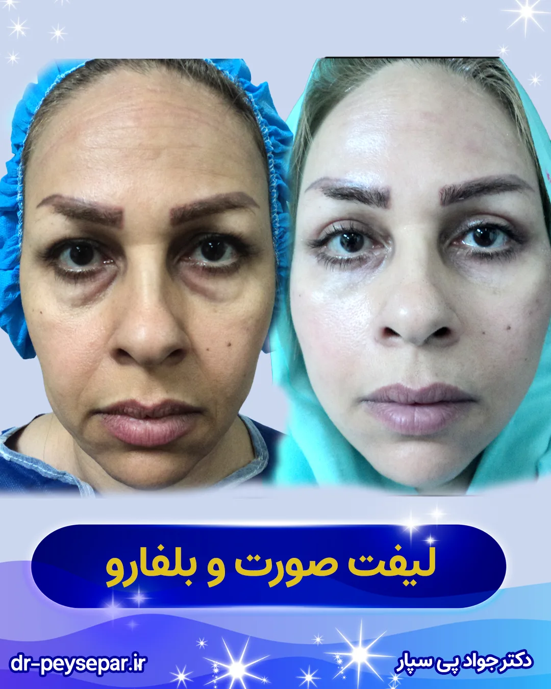 نمونه قبل بعد لیفت صورت – تغییرات خط فک و گونه –
