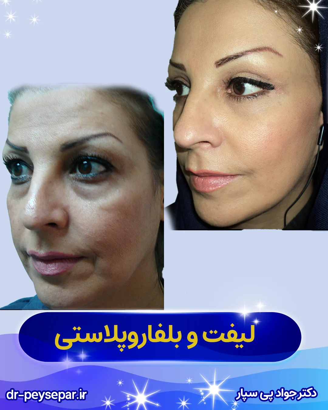 قبل و بعد لیفت صورت – جوانسازی و سفت شدن پوست – اهواز دکتر پی‌سپار