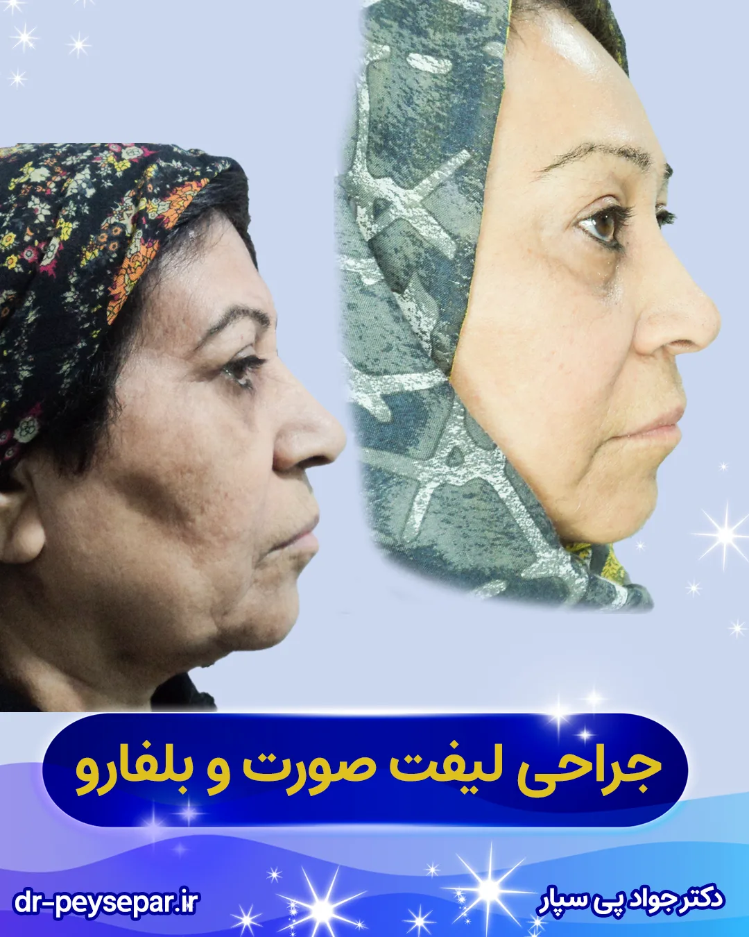 قبل و بعد لیفت صورت خانم در اهواز – نمای نیمرخ – دکتر پی‌سپار
