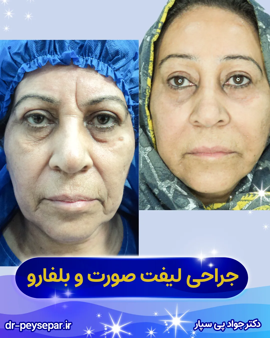 نتیجه لیفت صورت در اهواز – کاهش افتادگی گونه – دکتر پی‌سپار
